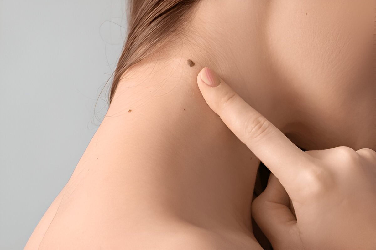 Mole Removal