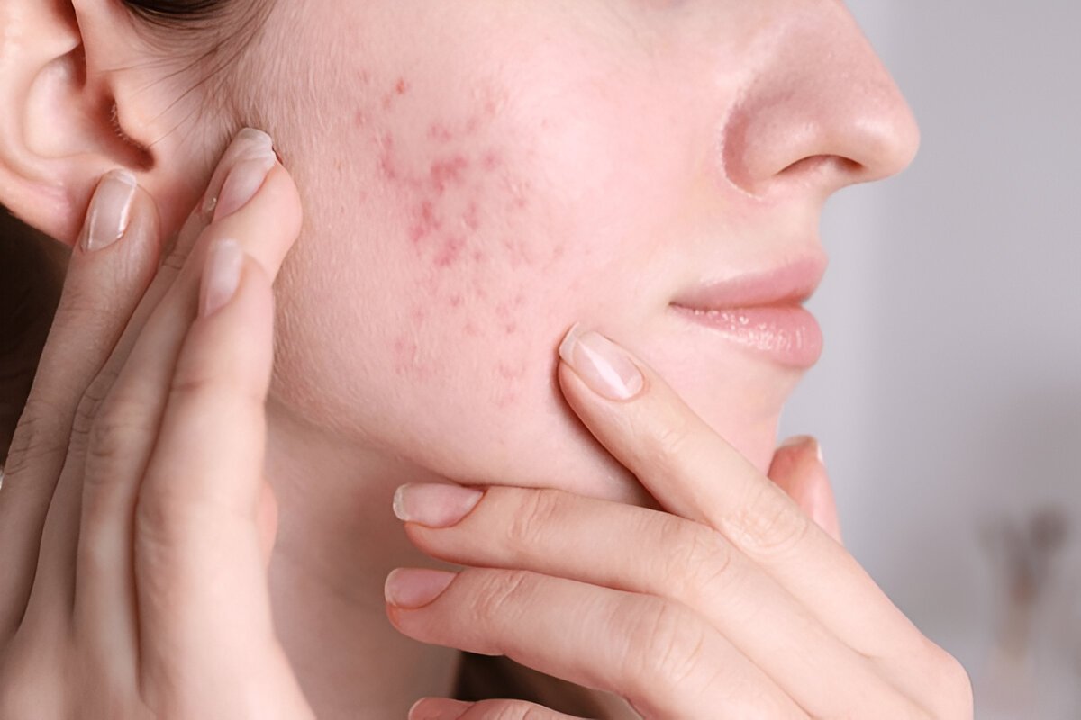 Acne Scarring Treatment in Dombivli & Kalyan – Keshavaa’s Skin & Hair Clinic